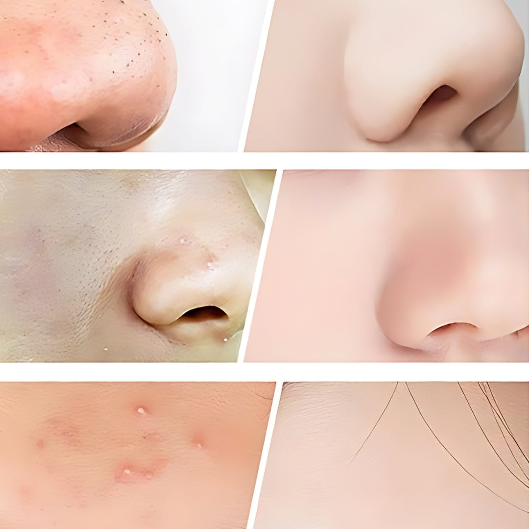 Aspy - Aspiratore Punti Neri 3 in 1